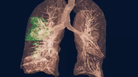 Lung